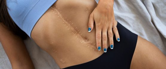CBD for Post-Surgery Recovery: What to Consider