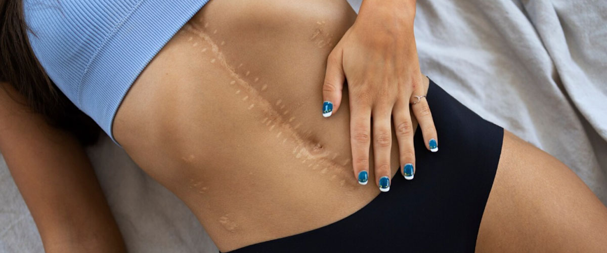 CBD for Post-Surgery Recovery: What to Consider